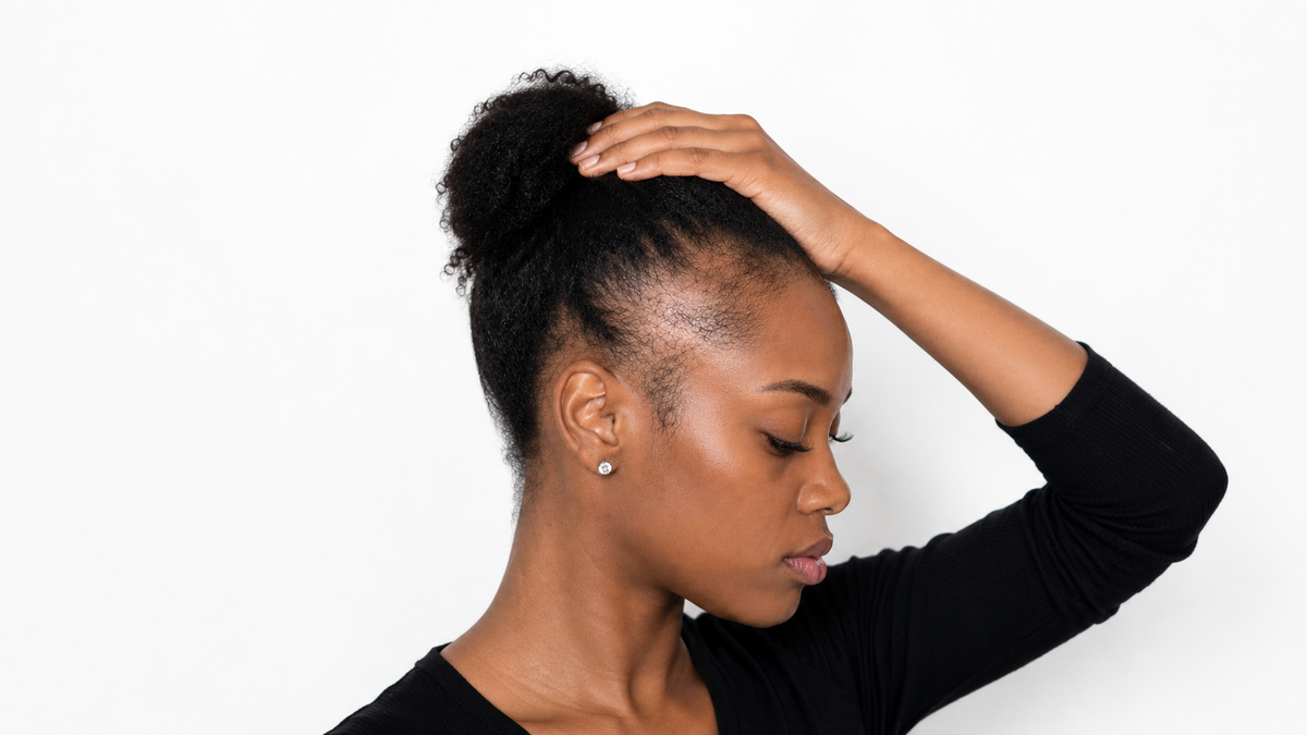 Femme noire présentant une alopécie de traction au niveau des tempes, avec une perte de densité visible sur la ligne capillaire.